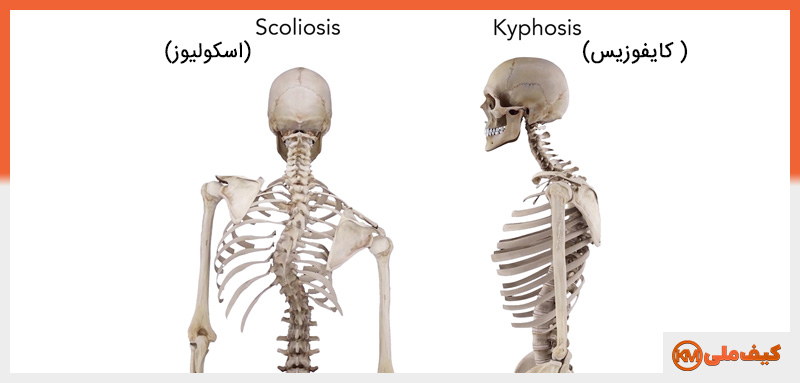 تاثیرات منفی سنگینی کیف و کوله مدرسه بر کودکان: ۵ تاثیر 5 تغییر شکل ستون فقرات از تأثیرات منفی سنگینی کیف و کوله مدرسه بر کودکان